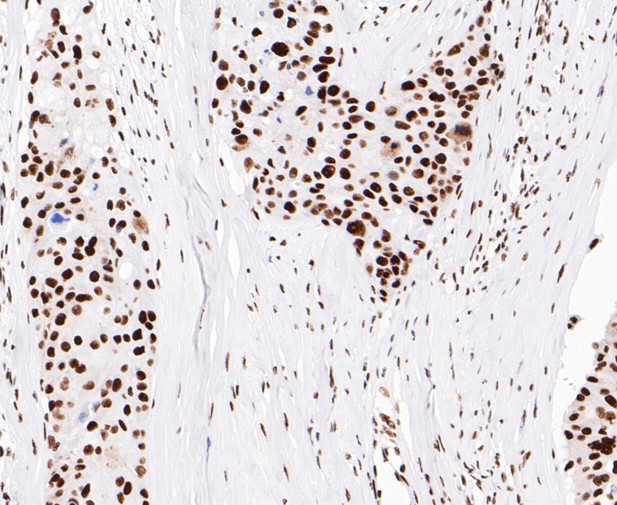 Paraformaldehyde-fixed, paraffin embedded Human breast cancer; Antigen retrieval by boiling in sodium citrate buffer (pH6.0) for 15min; Block endogenous peroxidase by 3% hydrogen peroxide for 20 minutes; Blocking buffer (normal goat serum) at 37°C for 30min; Antibody incubation with EWSR1/EWS Monoclonal Antibody, Unconjugated (bsm-54677R) at 1:200 for 30 minutes at room temperature, DAB staining.