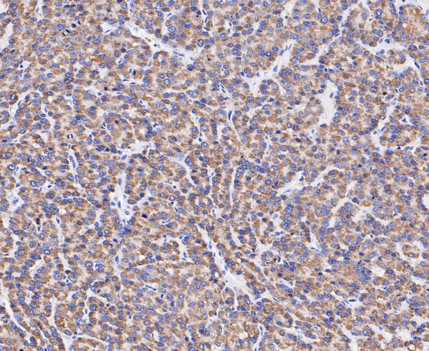 Paraformaldehyde-fixed, paraffin embedded Human liver cancer; Antigen retrieval by boiling in sodium citrate buffer (pH6.0) for 15min; Block endogenous peroxidase by 3% hydrogen peroxide for 20 minutes; Blocking buffer (normal goat serum) at 37°C for 30min; Antibody incubation with ABAT/GABA-T Monoclonal Antibody, Unconjugated (bsm-54681R) at 1:200 for 30 minutes at room temperature, DAB staining.