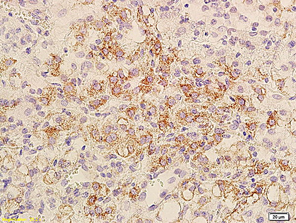 Formalin-fixed and paraffin embedded mouse transplant lymphoma labeled with Anti-Bcl-xL/BCL2L1/bcl-xs, Unconjugated (bs-1336R) at 1:800, followed by conjugation to the secondary antibody and DAB staining.