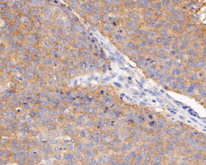 Paraformaldehyde-fixed, paraffin embedded Human lung cancer; Antigen retrieval by boiling in sodium citrate buffer (pH6.0) for 15min; Block endogenous peroxidase by 3% hydrogen peroxide for 20 minutes; Blocking buffer (normal goat serum) at 37°C for 30min; Antibody incubation with BCL2L12 Monoclonal Antibody, Unconjugated (bsm-54682R) at 1:400 for 30 minutes at room temperature, DAB staining.