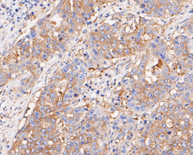 Paraformaldehyde-fixed, paraffin embedded Human gastric carcinoma; Antigen retrieval by boiling in sodium citrate buffer (pH6.0) for 15min; Block endogenous peroxidase by 3% hydrogen peroxide for 20 minutes; Blocking buffer (normal goat serum) at 37°C for 30min; Antibody incubation with BCL2L12 Monoclonal Antibody, Unconjugated (bsm-54682R) at 1:800 for 30 minutes at room temperature, DAB staining.