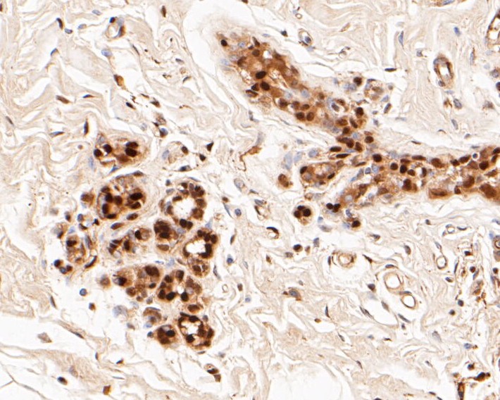 Paraformaldehyde-fixed, paraffin embedded Human breast; Antigen retrieval by boiling in sodium citrate buffer (pH6.0) for 15min; Block endogenous peroxidase by 3% hydrogen peroxide for 20 minutes; Blocking buffer (normal goat serum) at 37°C for 30min; Antibody incubation with LTA4H Monoclonal Antibody, Unconjugated (bsm-54689R) at 1:50 for 30 minutes at room temperature, DAB staining.