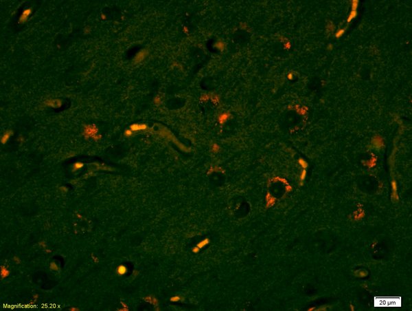 Formalin-fixed and paraffin embedded human glioma tissue labeled with Anti Lyn Polyclonal Antibody, PE conjugated (bs-2906R-PE) at 1:200 dilution for 60 minutes at 37\u00b0C.