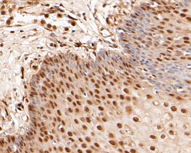 Paraformaldehyde-fixed, paraffin embedded Human esophagus; Antigen retrieval by boiling in sodium citrate buffer (pH6.0) for 15min; Block endogenous peroxidase by 3% hydrogen peroxide for 20 minutes; Blocking buffer (normal goat serum) at 37°C for 30min; Antibody incubation with LTA4H Monoclonal Antibody, Unconjugated (bsm-54689R) at 1:50 for 30 minutes at room temperature, DAB staining.