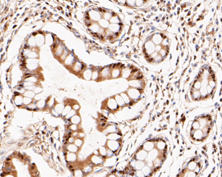 Paraformaldehyde-fixed, paraffin embedded Human intestine; Antigen retrieval by boiling in sodium citrate buffer (pH6.0) for 15min; Block endogenous peroxidase by 3% hydrogen peroxide for 20 minutes; Blocking buffer (normal goat serum) at 37°C for 30min; Antibody incubation with LTA4H Monoclonal Antibody, Unconjugated (bsm-54689R) at 1:50 for 30 minutes at room temperature, DAB staining.