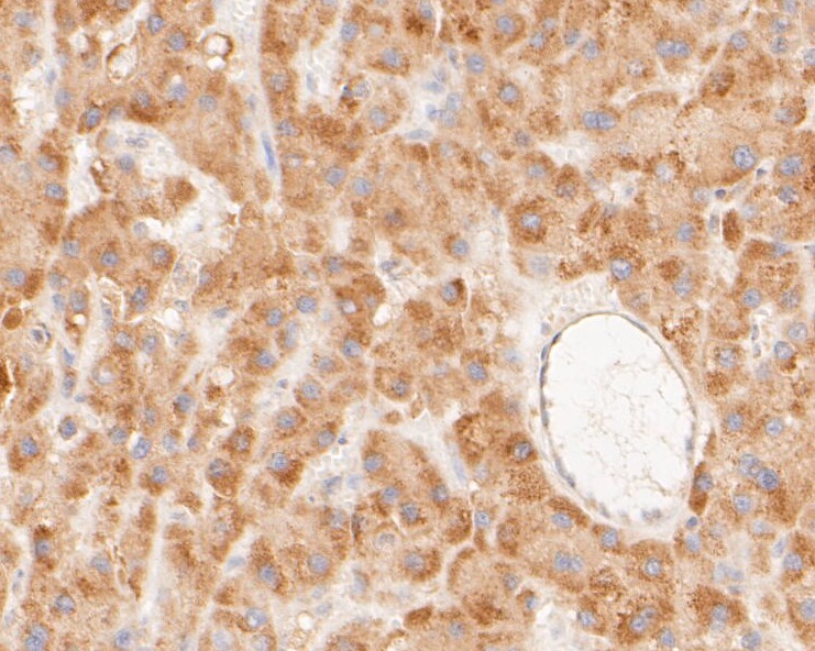 Paraformaldehyde-fixed, paraffin embedded Human liver cancer; Antigen retrieval by boiling in sodium citrate buffer (pH6.0) for 15min; Block endogenous peroxidase by 3% hydrogen peroxide for 20 minutes; Blocking buffer (normal goat serum) at 37°C for 30min; Antibody incubation with NEK7 Monoclonal Antibody, Unconjugated (bsm-54692R) at 1:200 for 30 minutes at room temperature, DAB staining.