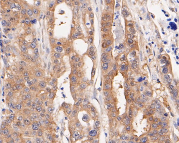Paraformaldehyde-fixed, paraffin embedded Human gastric carcinoma; Antigen retrieval by boiling in sodium citrate buffer (pH6.0) for 15min; Block endogenous peroxidase by 3% hydrogen peroxide for 20 minutes; Blocking buffer (normal goat serum) at 37°C for 30min; Antibody incubation with NUDC Monoclonal Antibody, Unconjugated (bsm-54694R) at 1:200 for 30 minutes at room temperature, DAB staining.