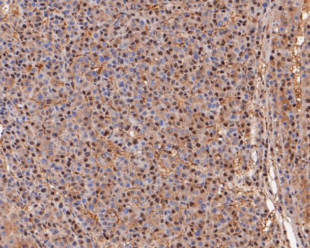 Paraformaldehyde-fixed, paraffin embedded Human liver cancer; Antigen retrieval by boiling in sodium citrate buffer (pH6.0) for 15min; Block endogenous peroxidase by 3% hydrogen peroxide for 20 minutes; Blocking buffer (normal goat serum) at 37°C for 30min; Antibody incubation with PSMA2 Monoclonal Antibody, Unconjugated (bsm-54695R) at 1:200 for 30 minutes at room temperature, DAB staining.