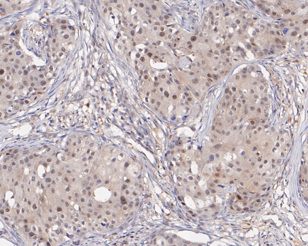 Paraformaldehyde-fixed, paraffin embedded Human breast cancer; Antigen retrieval by boiling in sodium citrate buffer (pH6.0) for 15min; Block endogenous peroxidase by 3% hydrogen peroxide for 20 minutes; Blocking buffer (normal goat serum) at 37°C for 30min; Antibody incubation with PSMA2 Monoclonal Antibody, Unconjugated (bsm-54695R) at 1:200 for 30 minutes at room temperature, DAB staining.