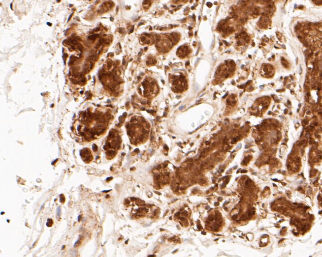 Paraformaldehyde-fixed, paraffin embedded Human breast; Antigen retrieval by boiling in sodium citrate buffer (pH6.0) for 15min; Block endogenous peroxidase by 3% hydrogen peroxide for 20 minutes; Blocking buffer (normal goat serum) at 37°C for 30min; Antibody incubation with PSMA3 Monoclonal Antibody, Unconjugated (bsm-54696R) at 1:50 for 30 minutes at room temperature, DAB staining.