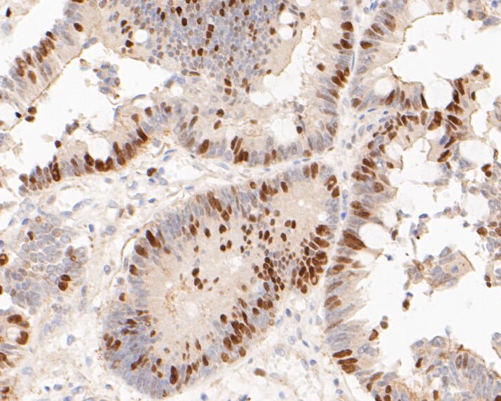 Paraformaldehyde-fixed, paraffin embedded Human colon cancer; Antigen retrieval by boiling in sodium citrate buffer (pH6.0) for 15min; Block endogenous peroxidase by 3% hydrogen peroxide for 20 minutes; Blocking buffer (normal goat serum) at 37°C for 30min; Antibody incubation with Timeless Monoclonal Antibody, Unconjugated (bsm-54697R) at 1:50 for 30 minutes at room temperature, DAB staining.