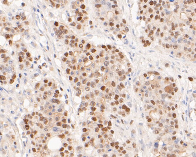 Paraformaldehyde-fixed, paraffin embedded Human gastric carcinoma; Antigen retrieval by boiling in sodium citrate buffer (pH6.0) for 15min; Block endogenous peroxidase by 3% hydrogen peroxide for 20 minutes; Blocking buffer (normal goat serum) at 37°C for 30min; Antibody incubation with Timeless Monoclonal Antibody, Unconjugated (bsm-54697R) at 1:50 for 30 minutes at room temperature, DAB staining.