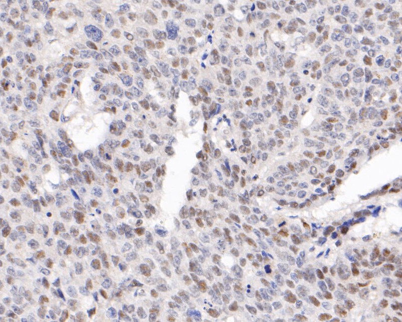 Paraformaldehyde-fixed, paraffin embedded Human lung cancer; Antigen retrieval by boiling in sodium citrate buffer (pH6.0) for 15min; Block endogenous peroxidase by 3% hydrogen peroxide for 20 minutes; Blocking buffer (normal goat serum) at 37°C for 30min; Antibody incubation with WAPL Monoclonal Antibody, Unconjugated (bsm-54699R) at 1:400 for 30 minutes at room temperature, DAB staining.