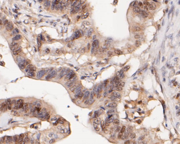 Paraformaldehyde-fixed, paraffin embedded Human colon cancer; Antigen retrieval by boiling in sodium citrate buffer (pH6.0) for 15min; Block endogenous peroxidase by 3% hydrogen peroxide for 20 minutes; Blocking buffer (normal goat serum) at 37°C for 30min; Antibody incubation with WAPL Monoclonal Antibody, Unconjugated (bsm-54699R) at 1:200 for 30 minutes at room temperature, DAB staining.