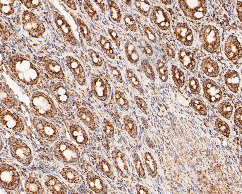 Paraformaldehyde-fixed, paraffin embedded Human colon; Antigen retrieval by boiling in sodium citrate buffer (pH6.0) for 15min; Block endogenous peroxidase by 3% hydrogen peroxide for 20 minutes; Blocking buffer (normal goat serum) at 37°C for 30min; Antibody incubation with LDHD Monoclonal Antibody, Unconjugated (bsm-54704R) at 1:200 for 30 minutes at room temperature, DAB staining.