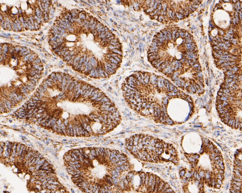 Paraformaldehyde-fixed, paraffin embedded Human colon colon; Antigen retrieval by boiling in sodium citrate buffer (pH6.0) for 15min; Block endogenous peroxidase by 3% hydrogen peroxide for 20 minutes; Blocking buffer (normal goat serum) at 37°C for 30min; Antibody incubation with LDHD Monoclonal Antibody, Unconjugated (bsm-54704R) at 1:200 for 30 minutes at room temperature, DAB staining.