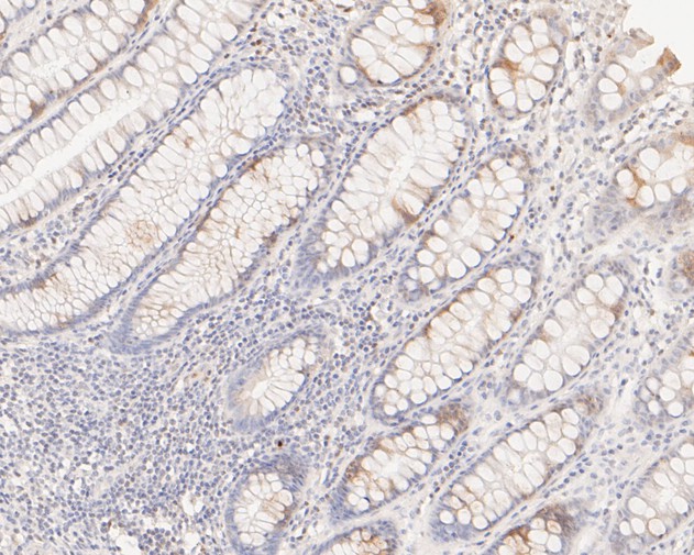 Paraformaldehyde-fixed, paraffin embedded Human colon; Antigen retrieval by boiling in sodium citrate buffer (pH6.0) for 15min; Block endogenous peroxidase by 3% hydrogen peroxide for 20 minutes; Blocking buffer (normal goat serum) at 37°C for 30min; Antibody incubation with SENP2 Monoclonal Antibody, Unconjugated (bsm-54707R) at 1:50 for 30 minutes at room temperature, DAB staining.