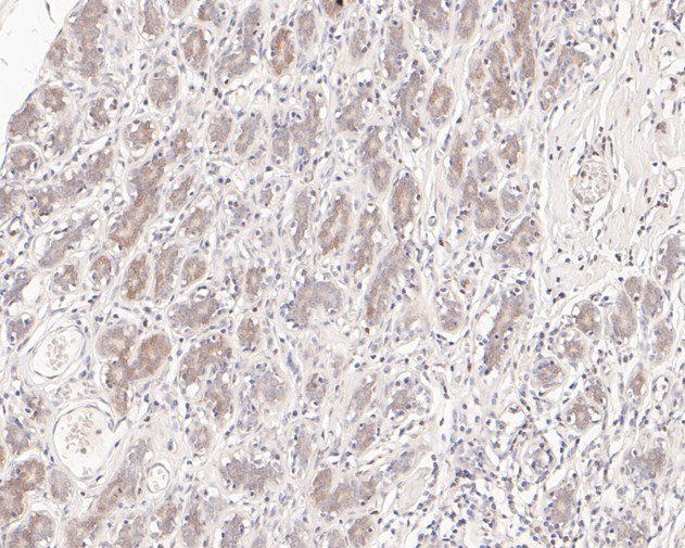 Paraformaldehyde-fixed, paraffin embedded Human breast; Antigen retrieval by boiling in sodium citrate buffer (pH6.0) for 15min; Block endogenous peroxidase by 3% hydrogen peroxide for 20 minutes; Blocking buffer (normal goat serum) at 37°C for 30min; Antibody incubation with SENP2 Monoclonal Antibody, Unconjugated (bsm-54707R) at 1:50 for 30 minutes at room temperature, DAB staining.