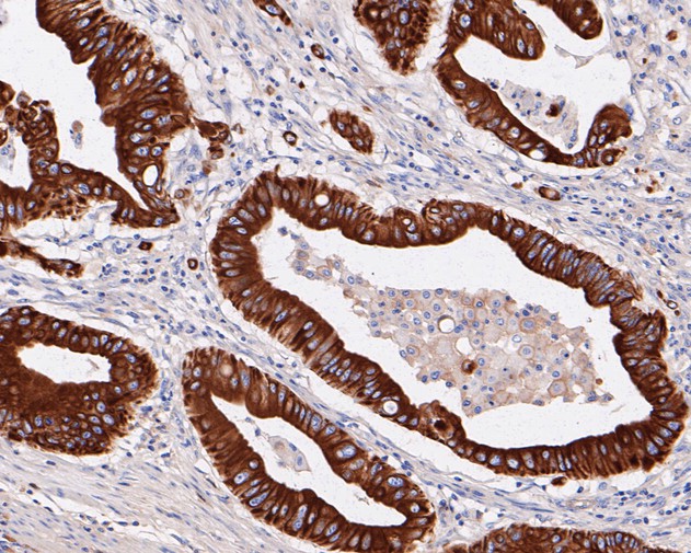 Paraformaldehyde-fixed, paraffin embedded Human colon cancer; Antigen retrieval by boiling in sodium citrate buffer (pH6.0) for 15min; Block endogenous peroxidase by 3% hydrogen peroxide for 20 minutes; Blocking buffer (normal goat serum) at 37°C for 30min; Antibody incubation with SLC22A3 Monoclonal Antibody, Unconjugated (bsm-54709R) at 1:50 for 30 minutes at room temperature, DAB staining.