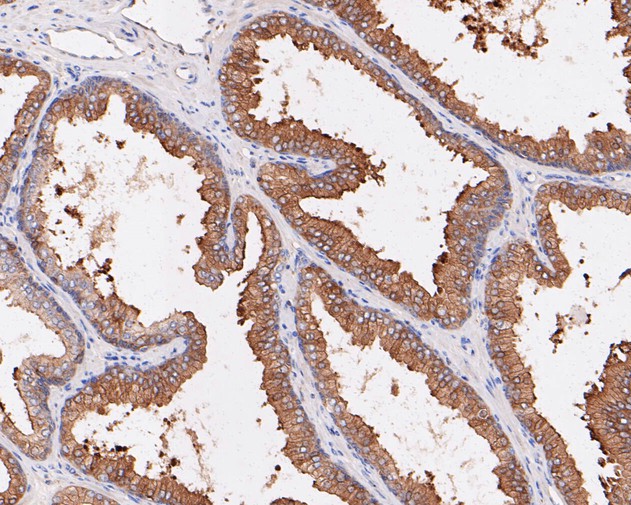 Paraformaldehyde-fixed, paraffin embedded Human prostate cancer; Antigen retrieval by boiling in sodium citrate buffer (pH6.0) for 15min; Block endogenous peroxidase by 3% hydrogen peroxide for 20 minutes; Blocking buffer (normal goat serum) at 37°C for 30min; Antibody incubation with SPAK Monoclonal Antibody, Unconjugated (bsm-54711R) at 1:50 for 30 minutes at room temperature, DAB staining.