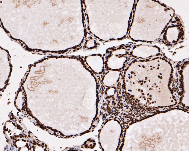 Paraformaldehyde-fixed, paraffin embedded Human thyroid; Antigen retrieval by boiling in sodium citrate buffer (pH6.0) for 15min; Block endogenous peroxidase by 3% hydrogen peroxide for 20 minutes; Blocking buffer (normal goat serum) at 37°C for 30min; Antibody incubation with HMGN2 Monoclonal Antibody, Unconjugated (bsm-54712R) at 1:200 for 30 minutes at room temperature, DAB staining.