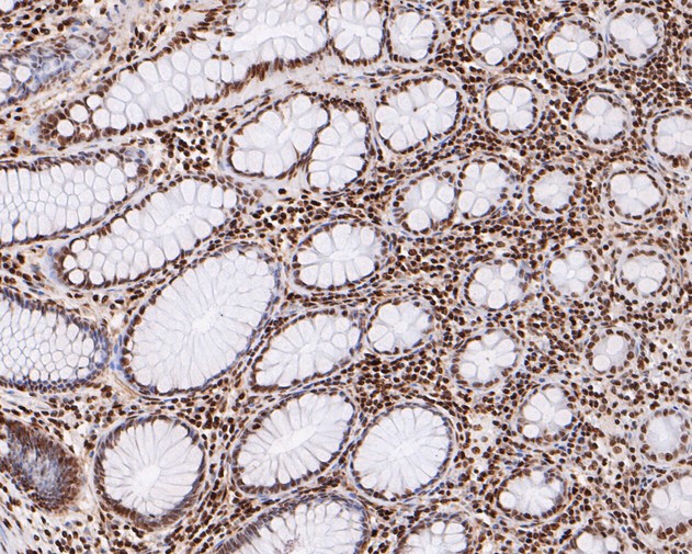 Paraformaldehyde-fixed, paraffin embedded Human colon; Antigen retrieval by boiling in sodium citrate buffer (pH6.0) for 15min; Block endogenous peroxidase by 3% hydrogen peroxide for 20 minutes; Blocking buffer (normal goat serum) at 37°C for 30min; Antibody incubation with HMGN2 Monoclonal Antibody, Unconjugated (bsm-54712R) at 1:200 for 30 minutes at room temperature, DAB staining.