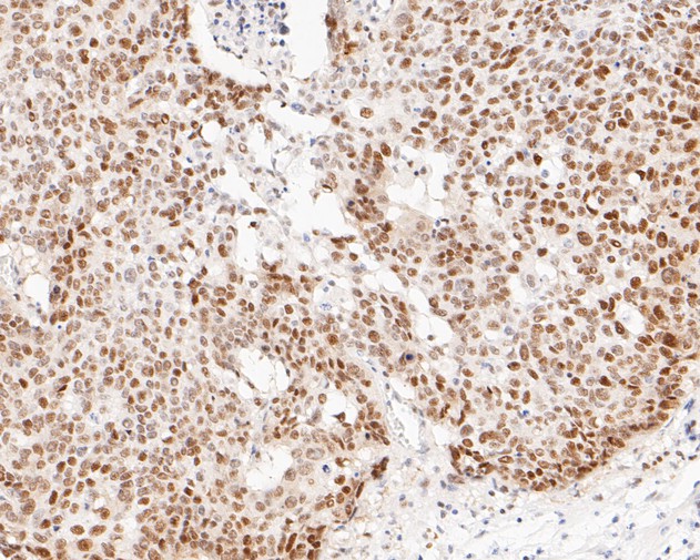 Paraformaldehyde-fixed, paraffin embedded Human lung cancer; Antigen retrieval by boiling in sodium citrate buffer (pH6.0) for 15min; Block endogenous peroxidase by 3% hydrogen peroxide for 20 minutes; Blocking buffer (normal goat serum) at 37°C for 30min; Antibody incubation with DP1 Monoclonal Antibody, Unconjugated (bsm-54717R) at 1:200 for 30 minutes at room temperature, DAB staining.