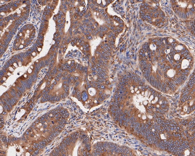 Paraformaldehyde-fixed, paraffin embedded Human colon cancer; Antigen retrieval by boiling in sodium citrate buffer (pH6.0) for 15min; Block endogenous peroxidase by 3% hydrogen peroxide for 20 minutes; Blocking buffer (normal goat serum) at 37°C for 30min; Antibody incubation with Elongation factor 1-gamma Monoclonal Antibody, Unconjugated (bsm-54719R) at 1:400 for 30 minutes at room temperature, DAB staining.