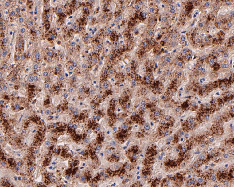 Paraformaldehyde-fixed, paraffin embedded Human liver; Antigen retrieval by boiling in sodium citrate buffer (pH6.0) for 15min; Block endogenous peroxidase by 3% hydrogen peroxide for 20 minutes; Blocking buffer (normal goat serum) at 37°C for 30min; Antibody incubation with ARF5 Monoclonal Antibody, Unconjugated (bsm-54720R) at 1:50 for 30 minutes at room temperature, DAB staining.
