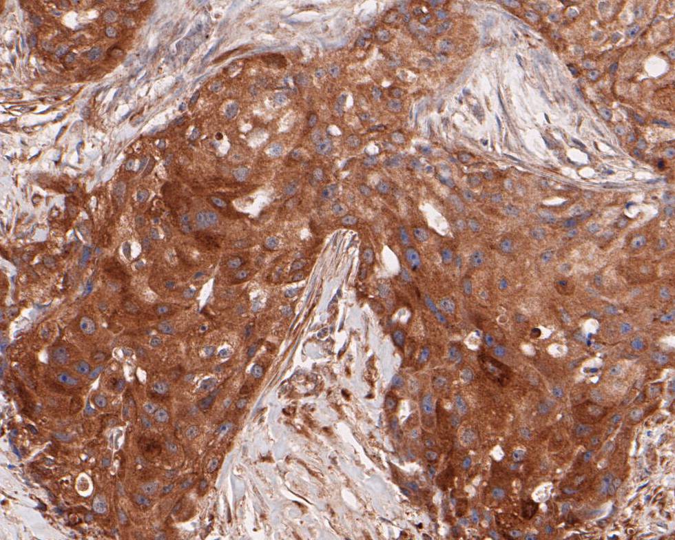 Paraformaldehyde-fixed, paraffin embedded Human breast cancer; Antigen retrieval by boiling in sodium citrate buffer (pH6.0) for 15min; Block endogenous peroxidase by 3% hydrogen peroxide for 20 minutes; Blocking buffer (normal goat serum) at 37°C for 30min; Antibody incubation with ARF5 Monoclonal Antibody, Unconjugated (bsm-54720R) at 1:50 for 30 minutes at room temperature, DAB staining.