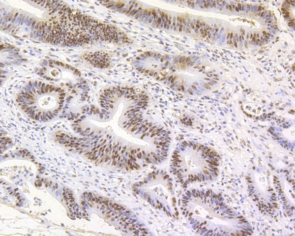 Paraformaldehyde-fixed, paraffin embedded Human colon cancer; Antigen retrieval by boiling in sodium citrate buffer (pH6.0) for 15min; Block endogenous peroxidase by 3% hydrogen peroxide for 20 minutes; Blocking buffer (normal goat serum) at 37°C for 30min; Antibody incubation with MSH2 Monoclonal Antibody, Unconjugated (bsm-54721R) at 1:50 for 30 minutes at room temperature, DAB staining. Paraformaldehyde-fixed, paraffin embedded Human colon cancer; Antigen retrieval by boiling in sodium citrate buffer (pH6.0) for 15min; Block endogenous peroxidase by 3% hydrogen peroxide for 20 minutes; Blocking buffer (normal goat serum) at 37°C for 30min; Antibody incubation with MSH2 Monoclonal Antibody, Unconjugated (bsm-54721R) at 1:50 for 30 minutes at room temperature, DAB staining.