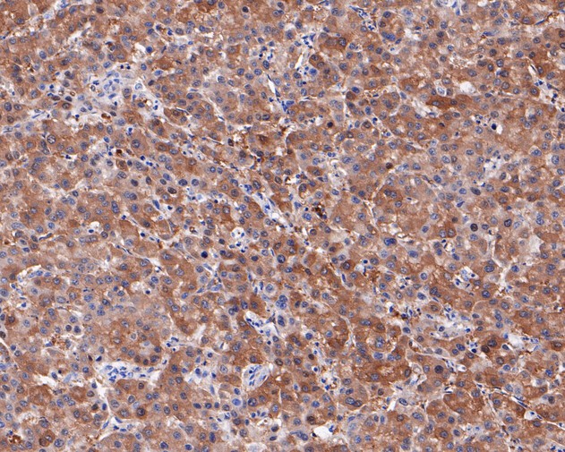 Paraformaldehyde-fixed, paraffin embedded Human liver cancer; Antigen retrieval by boiling in sodium citrate buffer (pH6.0) for 15min; Block endogenous peroxidase by 3% hydrogen peroxide for 20 minutes; Blocking buffer (normal goat serum) at 37°C for 30min; Antibody incubation with Neurocan Monoclonal Antibody, Unconjugated (bsm-54723R) at 1:50 for 30 minutes at room temperature, DAB staining.