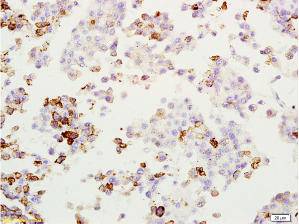 Formalin-fixed and paraffin embedded rat lung melanoma labeled with Anti-MAGE-1 Polyclonal Antibody, Unconjugated (bs-0817R) at 1:200, followed by conjugation to the secondary antibody and DAB staining