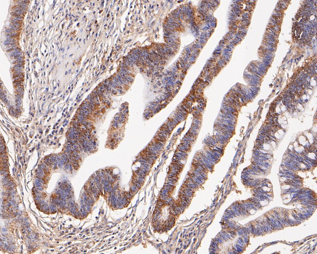 Paraformaldehyde-fixed, paraffin embedded Human colon cancer; Antigen retrieval by boiling in sodium citrate buffer (pH6.0) for 15min; Block endogenous peroxidase by 3% hydrogen peroxide for 20 minutes; Blocking buffer (normal goat serum) at 37°C for 30min; Antibody incubation with GOT2 Monoclonal Antibody, Unconjugated (bsm-54731R) at 1:200 for 30 minutes at room temperature, DAB staining.