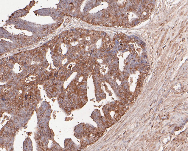 Paraformaldehyde-fixed, paraffin embedded Human prostate cancer; Antigen retrieval by boiling in sodium citrate buffer (pH6.0) for 15min; Block endogenous peroxidase by 3% hydrogen peroxide for 20 minutes; Blocking buffer (normal goat serum) at 37°C for 30min; Antibody incubation with TNFRSF19 Monoclonal Antibody, Unconjugated (bsm-54733R) at 1:200 for 30 minutes at room temperature, DAB staining.