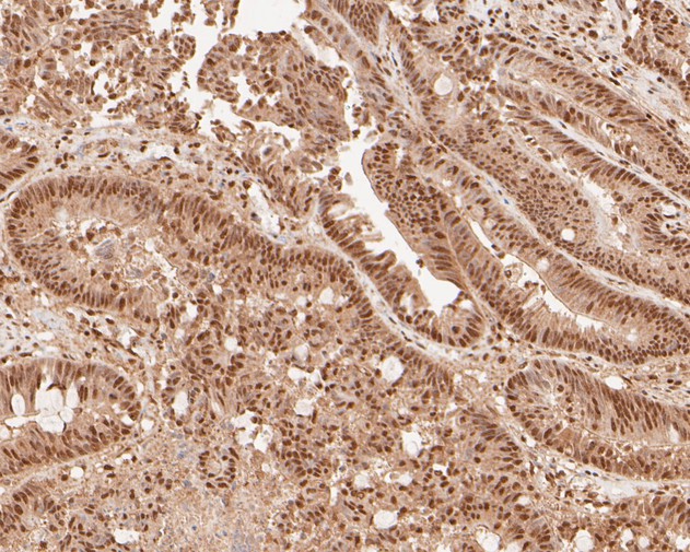 Paraformaldehyde-fixed, paraffin embedded Human colon cancer; Antigen retrieval by boiling in sodium citrate buffer (pH6.0) for 15min; Block endogenous peroxidase by 3% hydrogen peroxide for 20 minutes; Blocking buffer (normal goat serum) at 37°C for 30min; Antibody incubation with NFYA Monoclonal Antibody, Unconjugated (bsm-54741R) at 1:100 for 30 minutes at room temperature, DAB staining.