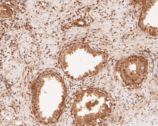 Paraformaldehyde-fixed, paraffin embedded Human prostate cancer; Antigen retrieval by boiling in sodium citrate buffer (pH6.0) for 15min; Block endogenous peroxidase by 3% hydrogen peroxide for 20 minutes; Blocking buffer (normal goat serum) at 37°C for 30min; Antibody incubation with NFYA Monoclonal Antibody, Unconjugated (bsm-54741R) at 1:100 for 30 minutes at room temperature, DAB staining.