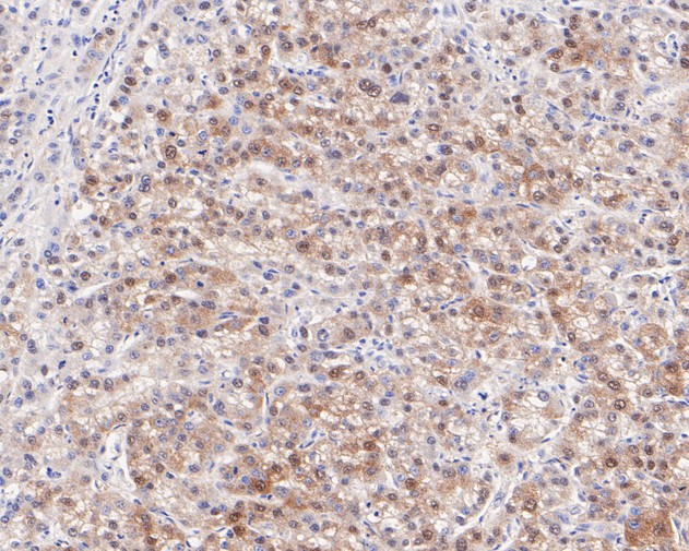Paraformaldehyde-fixed, paraffin embedded Human liver cancer; Antigen retrieval by boiling in sodium citrate buffer (pH6.0) for 15min; Block endogenous peroxidase by 3% hydrogen peroxide for 20 minutes; Blocking buffer (normal goat serum) at 37°C for 30min; Antibody incubation with PEX19 Monoclonal Antibody, Unconjugated (bsm-54745R) at 1:100 for 30 minutes at room temperature, DAB staining.