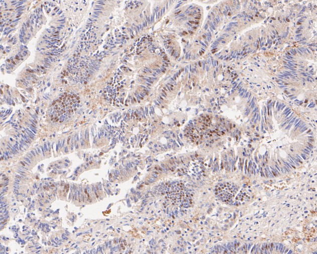 Paraformaldehyde-fixed, paraffin embedded Human colon cancer; Antigen retrieval by boiling in sodium citrate buffer (pH6.0) for 15min; Block endogenous peroxidase by 3% hydrogen peroxide for 20 minutes; Blocking buffer (normal goat serum) at 37°C for 30min; Antibody incubation with PEX19 Monoclonal Antibody, Unconjugated (bsm-54745R) at 1:100 for 30 minutes at room temperature, DAB staining.