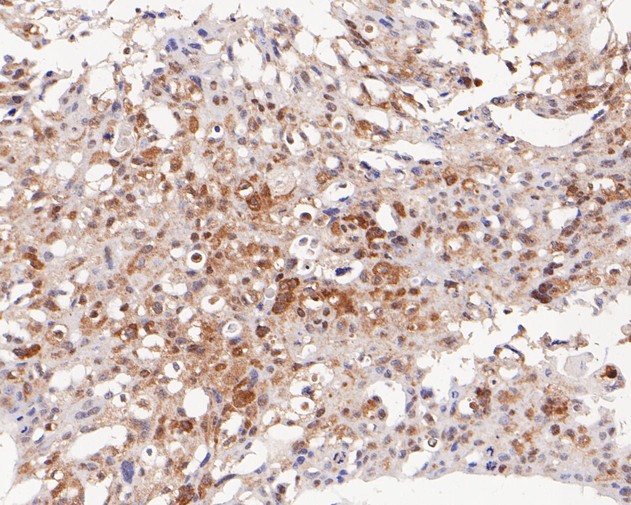 Paraformaldehyde-fixed, paraffin embedded Human breast cancer; Antigen retrieval by boiling in sodium citrate buffer (pH6.0) for 15min; Block endogenous peroxidase by 3% hydrogen peroxide for 20 minutes; Blocking buffer (normal goat serum) at 37°C for 30min; Antibody incubation with PEX19 Monoclonal Antibody, Unconjugated (bsm-54745R) at 1:100 for 30 minutes at room temperature, DAB staining.
