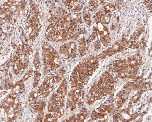 Paraformaldehyde-fixed, paraffin embedded Human gastric carcinoma; Antigen retrieval by boiling in sodium citrate buffer (pH6.0) for 15min; Block endogenous peroxidase by 3% hydrogen peroxide for 20 minutes; Blocking buffer (normal goat serum) at 37°C for 30min; Antibody incubation with PEX19 Monoclonal Antibody, Unconjugated (bsm-54745R) at 1:100 for 30 minutes at room temperature, DAB staining.