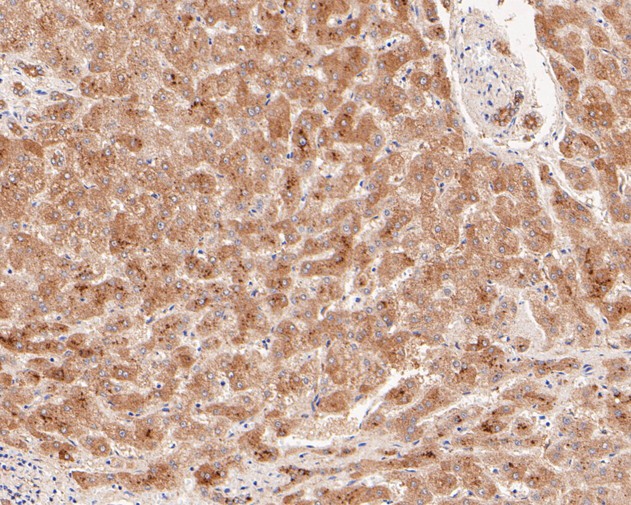 Paraformaldehyde-fixed, paraffin embedded Human liver; Antigen retrieval by boiling in sodium citrate buffer (pH6.0) for 15min; Block endogenous peroxidase by 3% hydrogen peroxide for 20 minutes; Blocking buffer (normal goat serum) at 37°C for 30min; Antibody incubation with Arg2 Monoclonal Antibody, Unconjugated (bsm-54747R) at 1:50 for 30 minutes at room temperature, DAB staining.