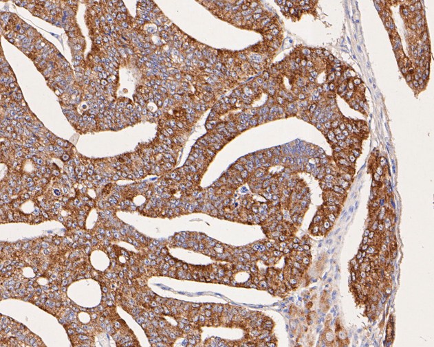 Paraformaldehyde-fixed, paraffin embedded Human prostate cancer; Antigen retrieval by boiling in sodium citrate buffer (pH6.0) for 15min; Block endogenous peroxidase by 3% hydrogen peroxide for 20 minutes; Blocking buffer (normal goat serum) at 37°C for 30min; Antibody incubation with Arg2 Monoclonal Antibody, Unconjugated (bsm-54747R) at 1:50 for 30 minutes at room temperature, DAB staining.