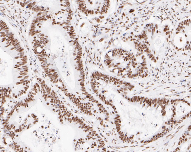 Paraformaldehyde-fixed, paraffin embedded Human colon cancer; Antigen retrieval by boiling in sodium citrate buffer (pH6.0) for 15min; Block endogenous peroxidase by 3% hydrogen peroxide for 20 minutes; Blocking buffer (normal goat serum) at 37°C for 30min; Antibody incubation with XPD Monoclonal Antibody, Unconjugated (bsm-54749R) at 1:200 for 30 minutes at room temperature, DAB staining.