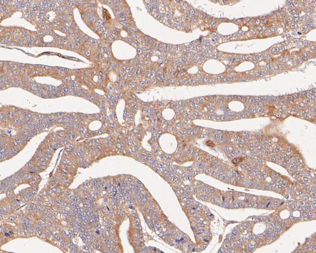 Paraformaldehyde-fixed, paraffin embedded Human prostate cancer; Antigen retrieval by boiling in sodium citrate buffer (pH6.0) for 15min; Block endogenous peroxidase by 3% hydrogen peroxide for 20 minutes; Blocking buffer (normal goat serum) at 37°C for 30min; Antibody incubation with VPS28 Monoclonal Antibody, Unconjugated (bsm-54750R) at 1:200 for 30 minutes at room temperature, DAB staining.