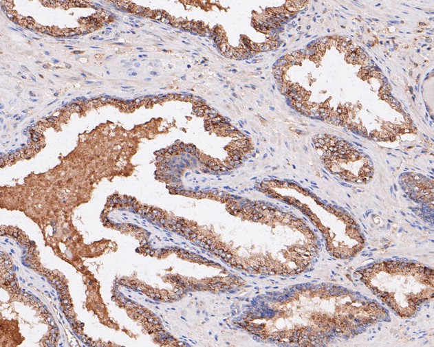 Paraformaldehyde-fixed, paraffin embedded Human prostate cancer; Antigen retrieval by boiling in sodium citrate buffer (pH6.0) for 15min; Block endogenous peroxidase by 3% hydrogen peroxide for 20 minutes; Blocking buffer (normal goat serum) at 37°C for 30min; Antibody incubation with PLAP Monoclonal Antibody, Unconjugated (bsm-54760R) at 1:50 for 30 minutes at room temperature, DAB staining.