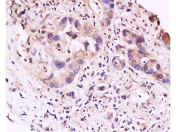 Formalin-fixed and paraffin embedded human gastric carcinoma labeled with Anti-IL-23R Polyclonal Antibody, Unconjugated (bs-1460R) at 1:200 followed by conjugation to the secondary antibody and DAB staining