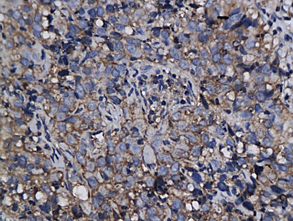 Formalin-fixed and paraffin embedded cervical intraepithelial xenograft labeled with Anti-Annexin VI Polyclonal Antibody, Unconjugated (bs-1471R)  followed by conjugation to the secondary antibody and DAB staining