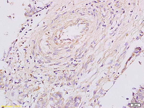 Formalin-fixed and paraffin embedded human esophageal carcinoma labeled with Anti PGRN/Granulin Polyclonal Antibody,Unconjugated (bs-0823R) at 1:200 followed by conjugation to the secondary antibody and DAB staining.
