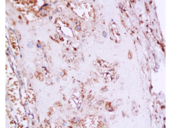 Formalin-fixed and paraffin embedded human placenta tissue labeledwith Anti-Phospho-Estrogen Receptor alpha (Ser167) Polyclonal Antibody, Unconjugated (bs-0894R) at 1:200, followed by conjugation to the secondary antibody and DAB staining